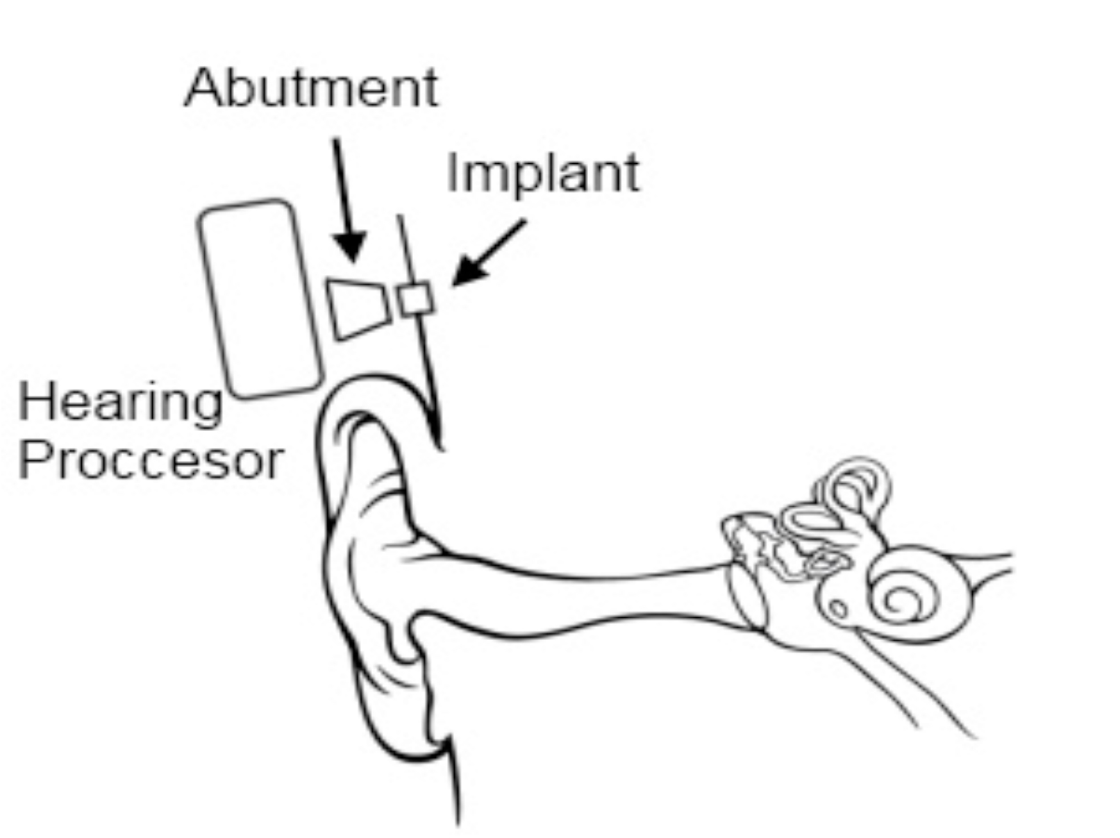 Hearing Processor CI