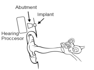 Hearing Processor CI